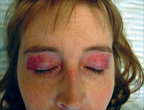 A 38 Year Old Woman With Eyelid Discoloration—quiz Case Dermatology