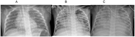 Serial Chest Radiographs Of A 2 Year Old Boy 2a Shows Bilaterally