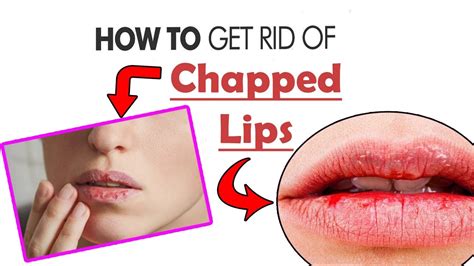 How To Get Rid Of Chapped Lips Fast Naturally At Home Home Remedies