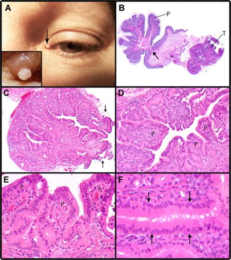 Papillary Hidradenoma Of The Eyelid Margin Clinical And