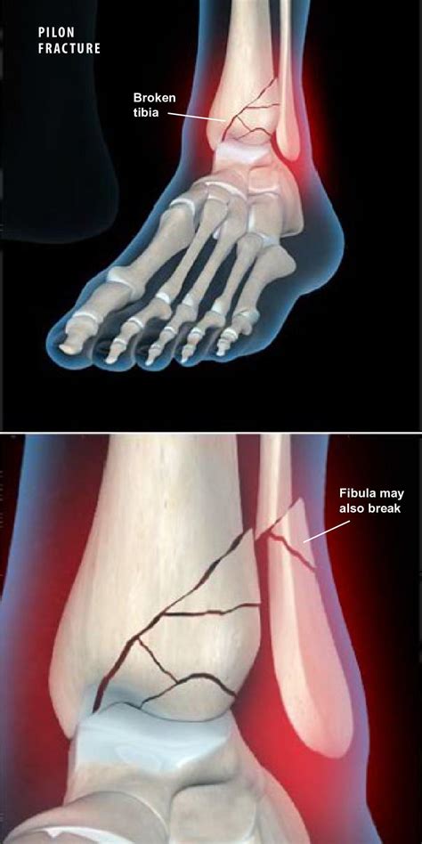 Tibial Pilon Fractures Classification Ankle Fracture Orthopedic My XXX Hot Girl