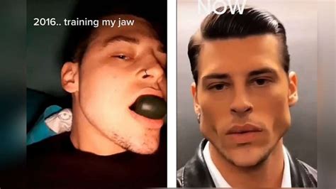 Model Trains His Jaw For Months For Stunning Face Transformation Check Pics Here