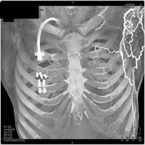 Venous Catheter With Clot In Superior Vena Cava Svc