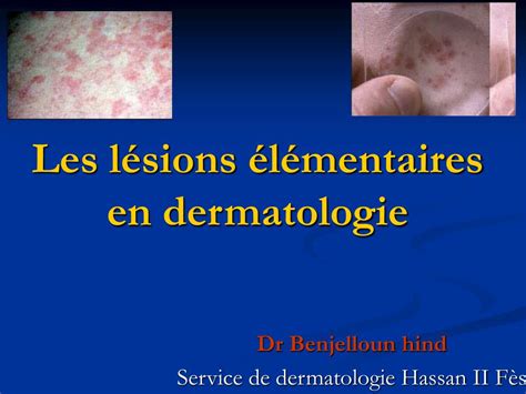 Ppt Les Lésions élémentaires En Dermatologie Powerpoint Presentation