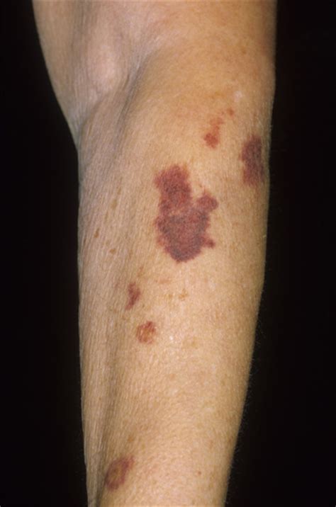Melanoma Purple Skin Patch