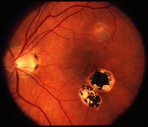Presumed Ocular Histoplasmosis Syndrome Retina Image Bank