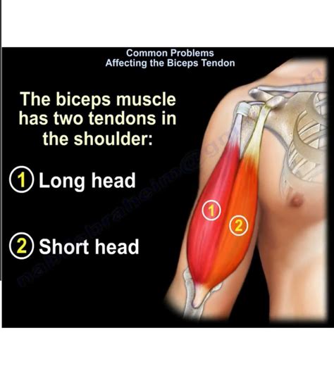 Biceps Tendon Pathologies —