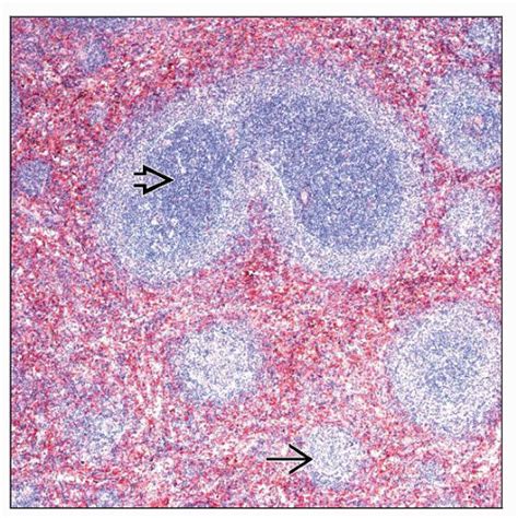 Marginal Zone Lymphoma Histology