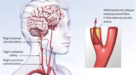 Pin By Podcastdx Llc On Stroke Internal Carotid Artery Stroke