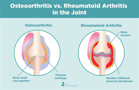 Osteoarthritis May Have More Comorbidities Than Rheumatoid Arthritis