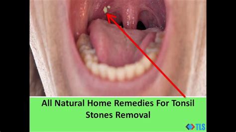 All Natural Home Remedies For Tonsil Stones Removal Youtube