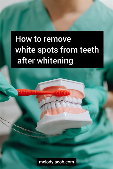 How To Remove White Spots From Teeth After Whitening Melody Jacob