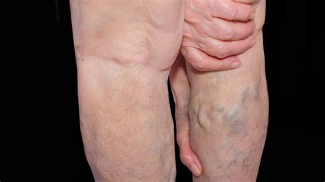 Varicose Veins May Increase Risk Of Blood Clots Lead To