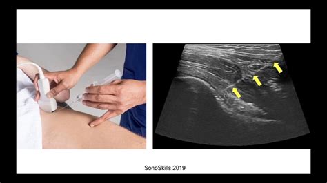 Ultrasound Guided Musculoskeletal Injections Demonstration Webinar