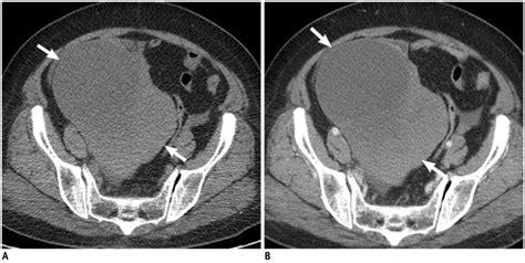 63 Year Old Woman With Complaint Of Pelvic Mass Unenhanced Ct Scan A