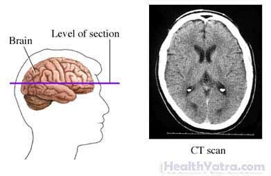 The cardiac ct scanner cost a lot of money. Best Cost CT Scan of the Head Surgery, Treatment Hospital ...