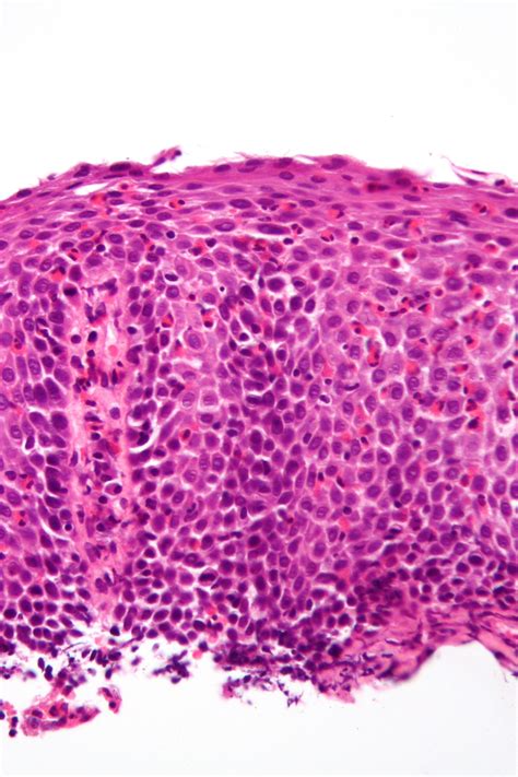 Fileeosinophilic Esophagitis 2 Very High Mag Libre Pathology