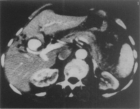 Ct Scan Of The Upper Abdomen After Injection Of Intravenous Contrast