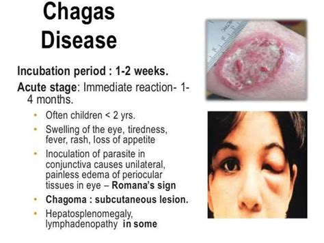 CHAGAS DISEASE MEDizzy