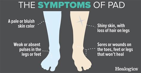 Peripheral Arterial Disease The Chorley Surgery