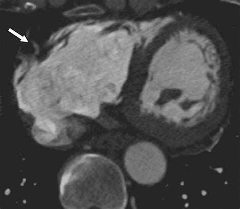 Artifacts At Cardiac Ct Physics And Solutions Radiographics