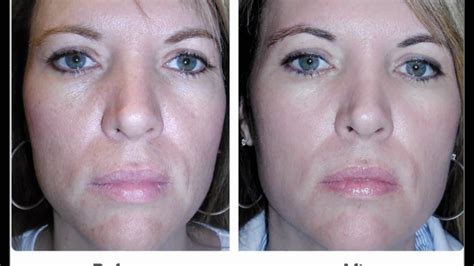 Face Wrinkles Before And After Pictures Youtube