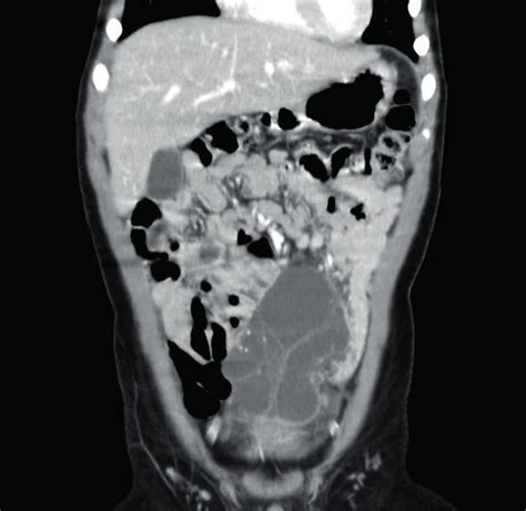 Abdominal Computed Tomography Scan With Intravenous Contrast