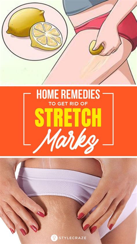 How To Remove Stretch Marks 29 Effective Home Remedies Stretch