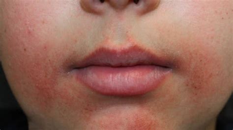 Perioral Dermatitis In Adults Healthy Food Near Me