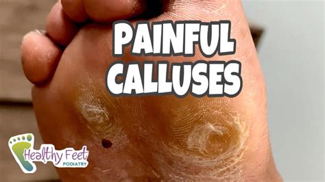 Callus Removal At Home So Satisfying Youtube