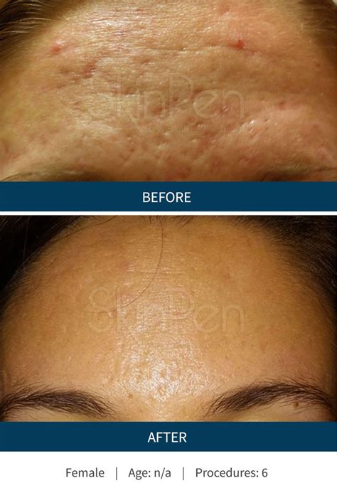 Microneedling Can Be Used On All Parts Of The Body Face Neck