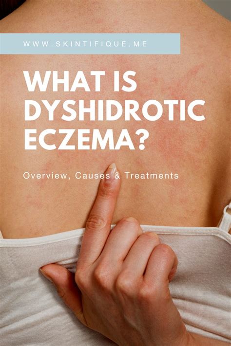 What Is Dyshidrotic Eczema In 2021 Eczema Treatment