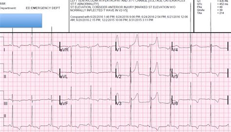 Dr Smiths Ecg Blog Is This Stemi Lvh Early Repolarization
