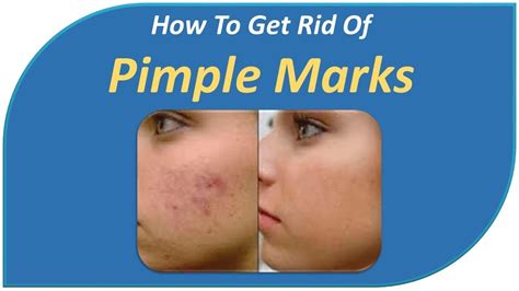 How To Get Rid Of Pimple Marks Youtube