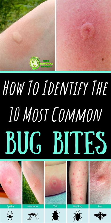 10 Bug Bites Anyone Should Be Able To Identify In 2020 Bug Bites