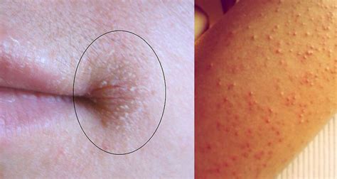 Weird Bumps And Cracked Lips You Might Be Suffering From This Common