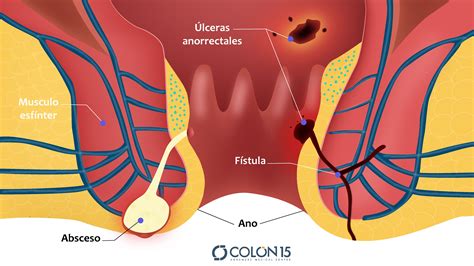 Abscesos Fístulas e infecciones anorrectales Medicos Ilustración