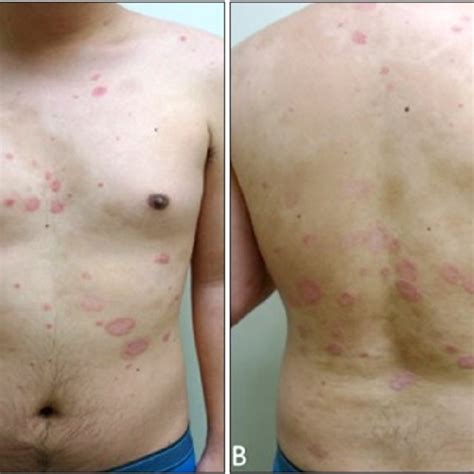 A B Paradoxical Flare Of Plaque Type Psoriasis After The Fourth