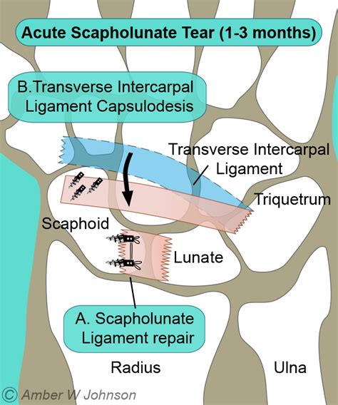 Scapholunate Ligament Injury Alaska Hand Elbow