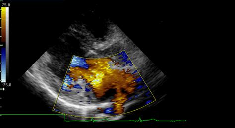 Als ultraschall bezeichnet man schall mit frequenzen oberhalb des hörfrequenzbereichs des menschen. Herzmuskelentzündung, Myokarditis
