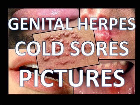 Both herpes simplex viruses 1 and 2 produce similar symptoms, but they can differ in severity depending on the site of infection. Herpes Simplex Virus Pictures Infection Treatment - YouTube