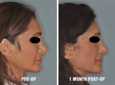 Sort Tondre Ville Tip Swelling After Rhinoplasty Postscript Malheur Main