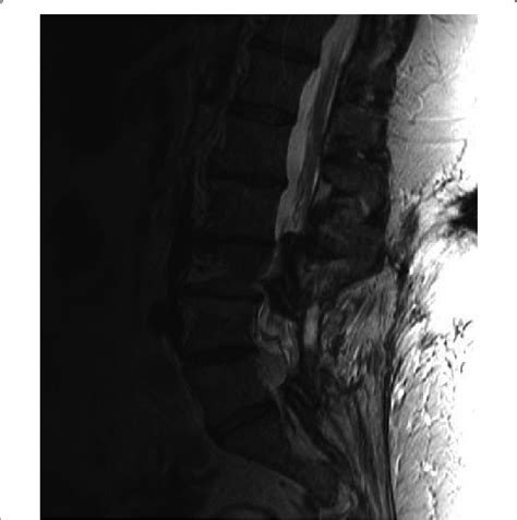 L4 L5 Disc In The Left Lateral Recess With Inhomogeneous Contrast