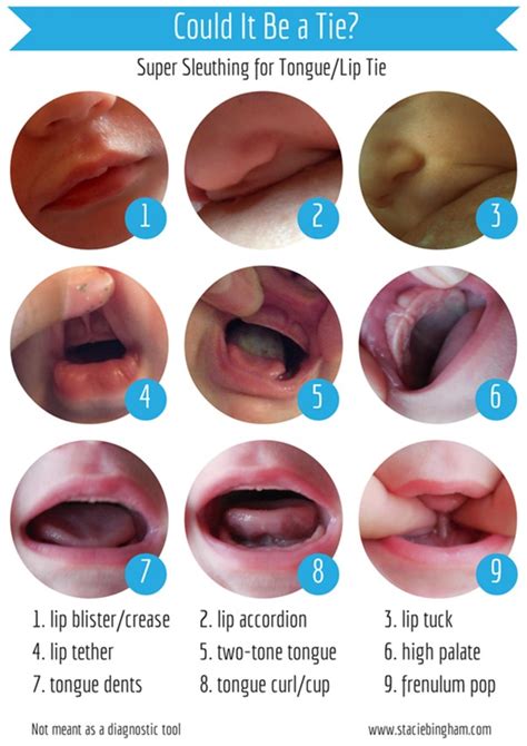 Tongue And Lip Tie Therapy South African Airway And Myofunctional Society