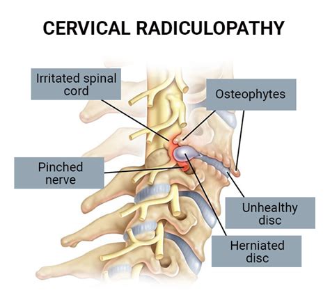 Cervical Radiculopathy Treatment In NJ NYC