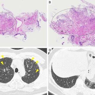 A Case In Which The Pathology Diagnosis By Transbronchial Lung Download Scientific Diagram