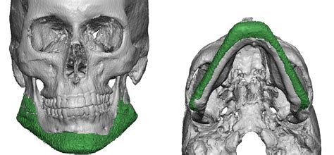 3d Ct Scan Of Custom Jawline Implant Positioning Dr Barry Eppley