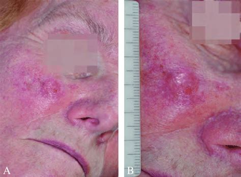 The Patient With Amelanotic Melanoma Of The Upper Middle Check A Low