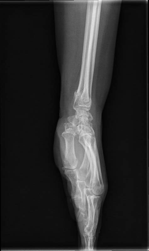 X Ray Wrist Joint Post Trauma Radiology Imaging