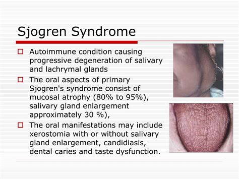 Ppt Salivary Glands Disorders Powerpoint Presentation Free Download
